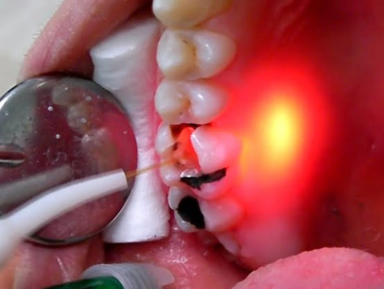 Dentist Near Me - Best Dental Clinic - LASER AND MICROSCOPE ASSISTED RCT