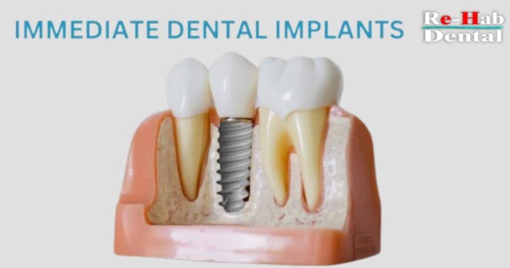 How to Choose a Dentist for Dental Implants