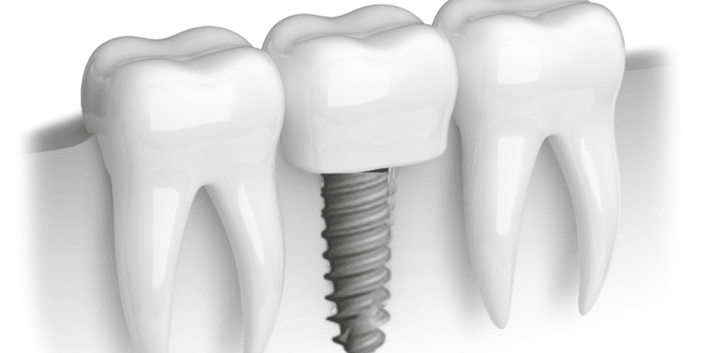 Exploring The Affordable Solutions For Teeth Replacement Understanding Dental Implant Costs
