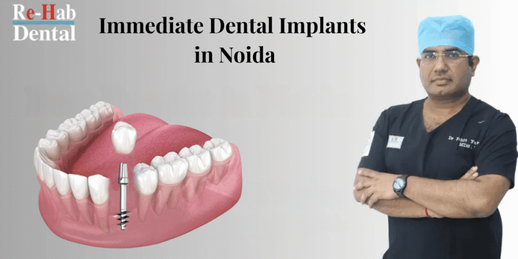 Discover Immediate Dental Implants in Noida with Dr. Rohit Yadav – A Trusted Name in Modern Implantology