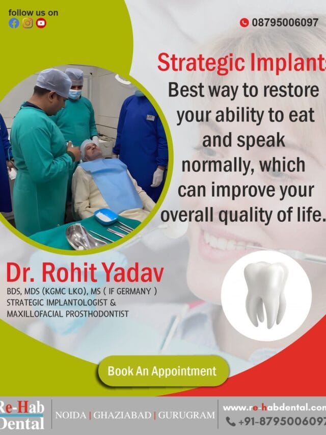 Strategic Implants: The Game-Changer in Modern Tooth Replacement You Need to Know About!